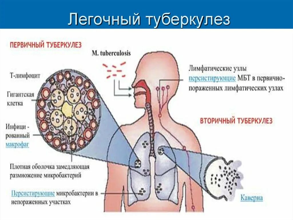 Почему заболел туберкулезом