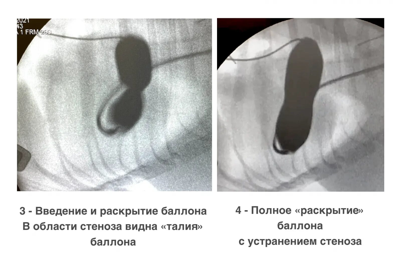 Стеноз у собак. Баллонная вальвулопластика клапана легочной артерии. Стеноз легочной артерии вальвулопластика. Вальвулопластика легочной артерии. Вальвулопластика клапана легочной артерии.