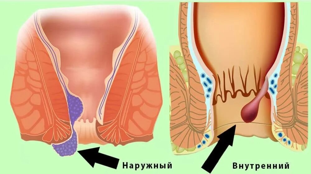 Боли внутри заднего прохода. Что внутри геморройного узла. Геморройный узел наружный. Внутренние геморроидальные узлы. Тромбированный узел геморрой.