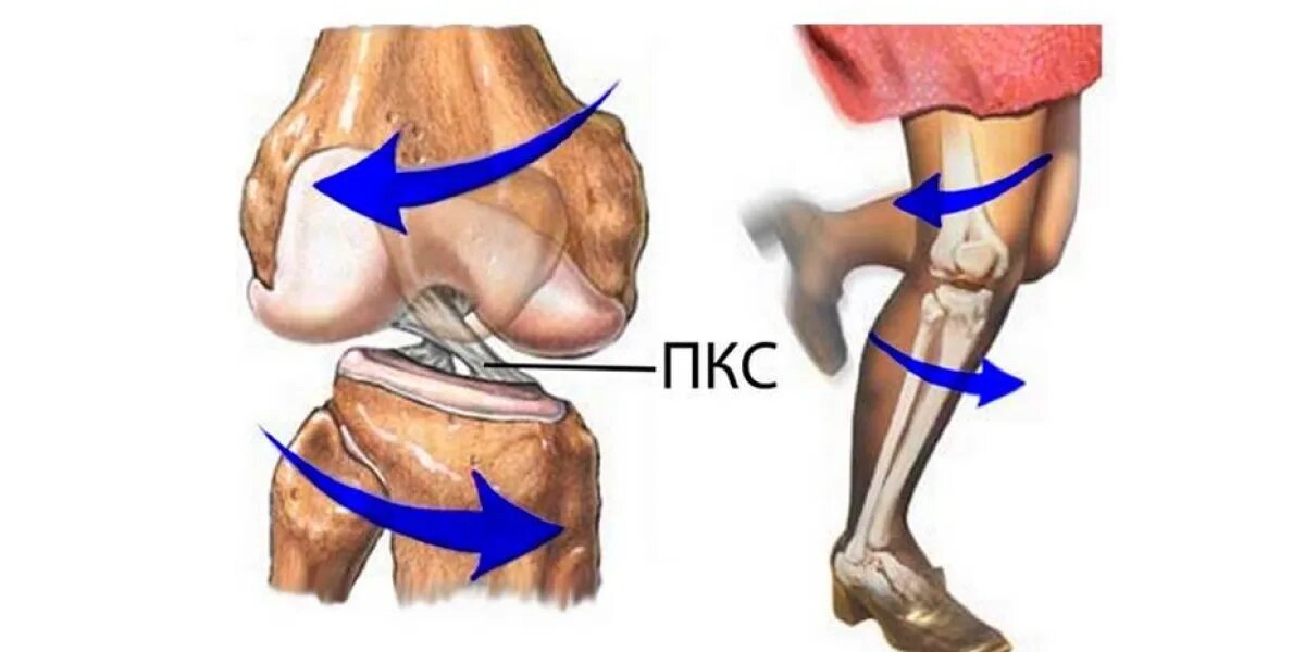 Травма связок сустава. Механизм травмы передней крестообразной связки коленного сустава. Механизм разрыва передней крестообразной связки. Механизм разрыв мениска коленного сустава. Разрыв связок ПКС коленного сустава.