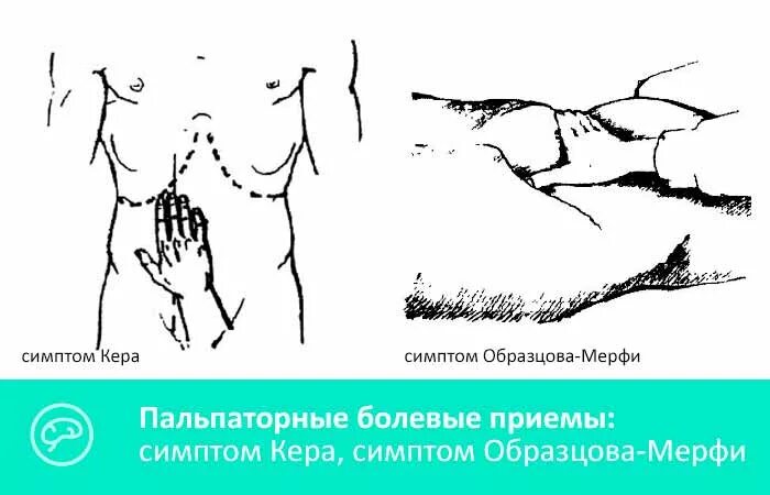 Болевые точки. Болевые точки и болевые симптомы. Симптомы мюсси-георгиевского ортнера образцова-мерфи. Симптомы кера мерфи мейо робсона. Точка кера.