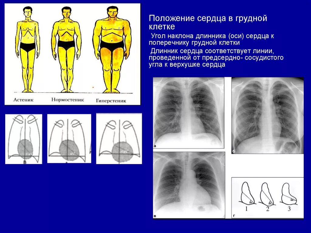 Вертикальная позиция сердца. Косое положение сердца. Типы положения сердца. Угол наклона сердца.