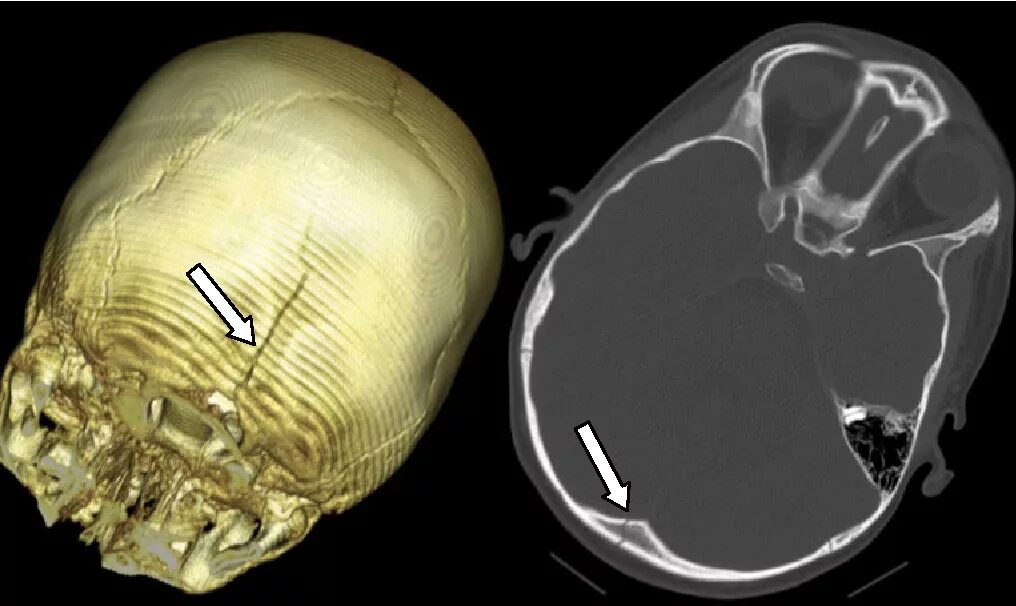 Трещина черепа у ребенка. Перелом основания черепа на кт. Перелом теменной кости на кт. Перелом теменной кости черепа рентген. Вдавленный перелом теменной кости кт.