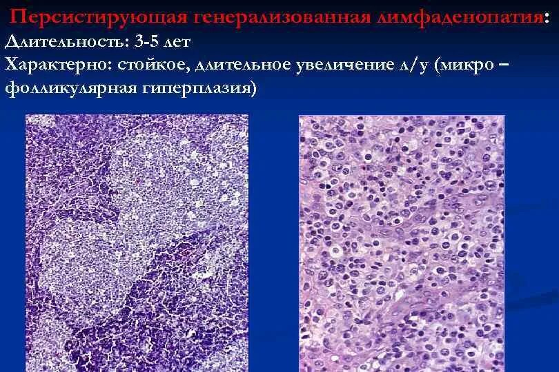 Фолликулярная гиперплазия. Персистирующая лимфаденопатия. Персистирующая генерализованная лимфаденопатия. Фолликулярная гиперплазия лимфатического узла. Реактивная гиперплазия лимфоузла