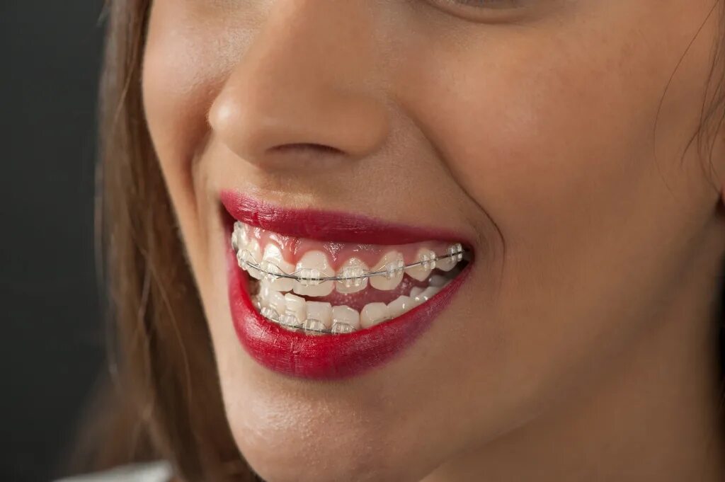 Mr brackets