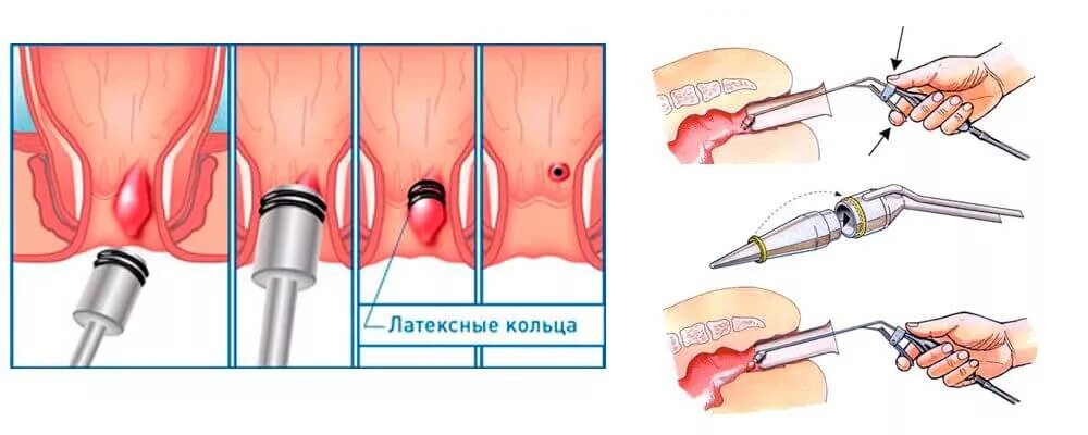 Геморр. Латексное лигирование геморроидальных узлов. Лигирование внутренних геморроидальных узлов. Лигирование геморроя латексными кольцами. Лигирование узлов латексными кольцами.