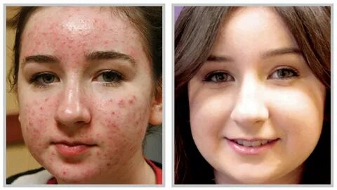 Acne removing