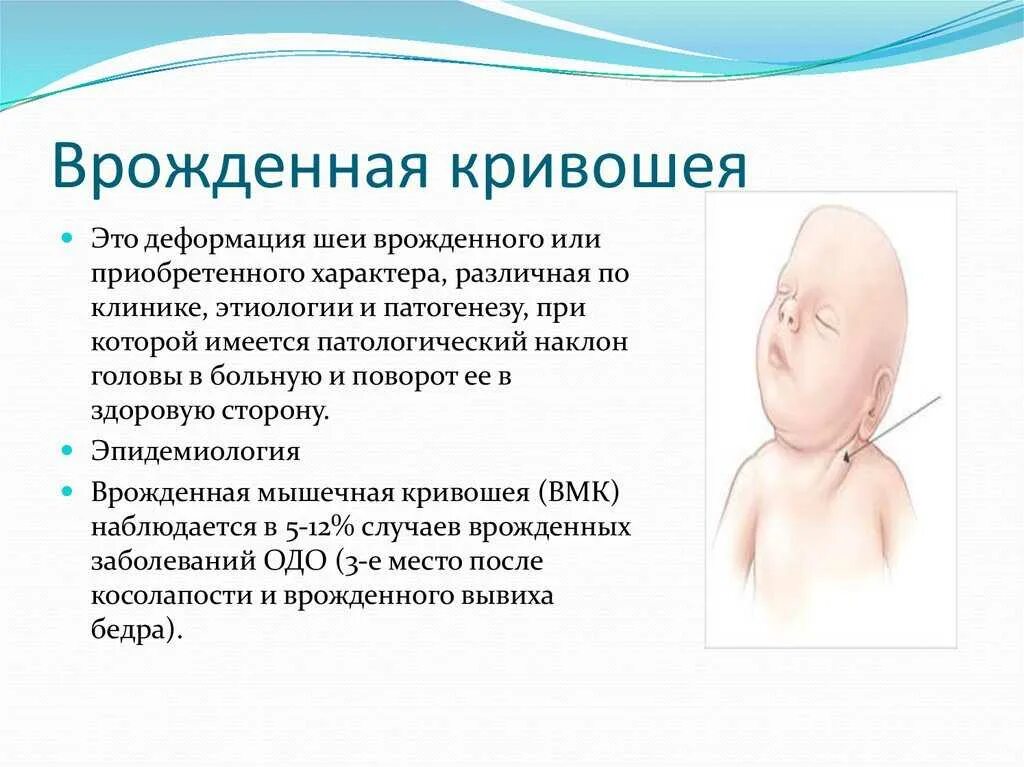 Правосторонняя кривошея. Врождённая кривошея новорожденного. Кривая шея у детей. Кривошее у новорожденных. Мышечная кривошея у новорожденных.