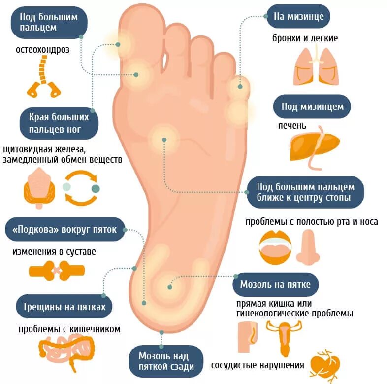Болят ступни ног к какому врачу. Натоптыш на ступне сбоку с внешней стороны. Стержневая мозоль на стопе.