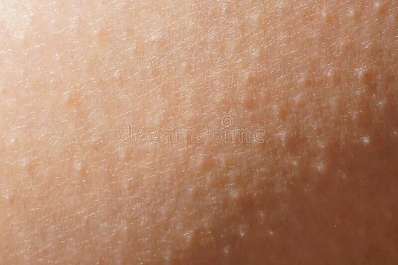 Беременная женщина растяжки. Состояние кожи. Раздраженная кожа лица. Сухость кожи при беременности. Сухость кожи при беременности.