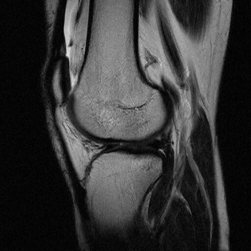Мрт коленного сустава омс. Снимок мрт колена крестообразная связка. Разрыв передней крестообразной связки мрт. Повреждение передней крестообразной связки мрт.