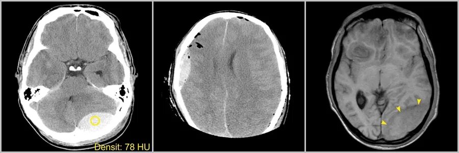 острая субдуральная гематома кт. субдуральная гематома черепа. гематома мозга кт. кт эпидуральной гематомы. эпидуральная гематома головного мозга кт.