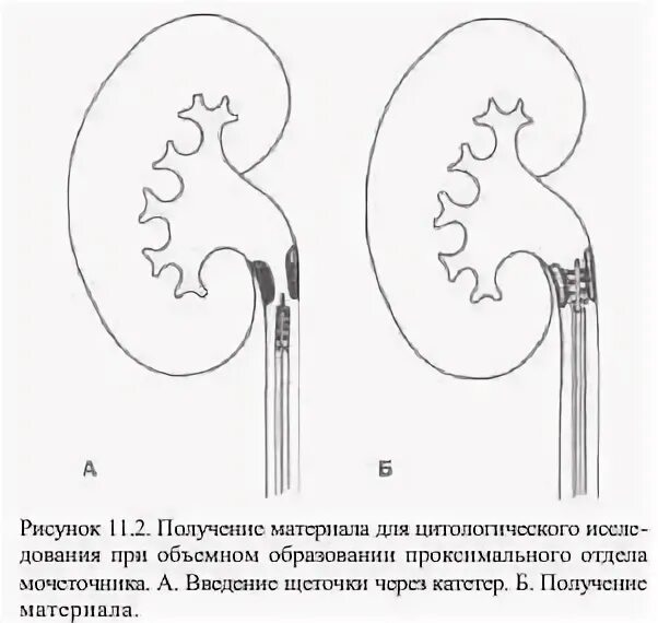 Катетеризация мочеточника. Введение геля в мочеточник ребенку. Миграция стента мочеточника на кт.