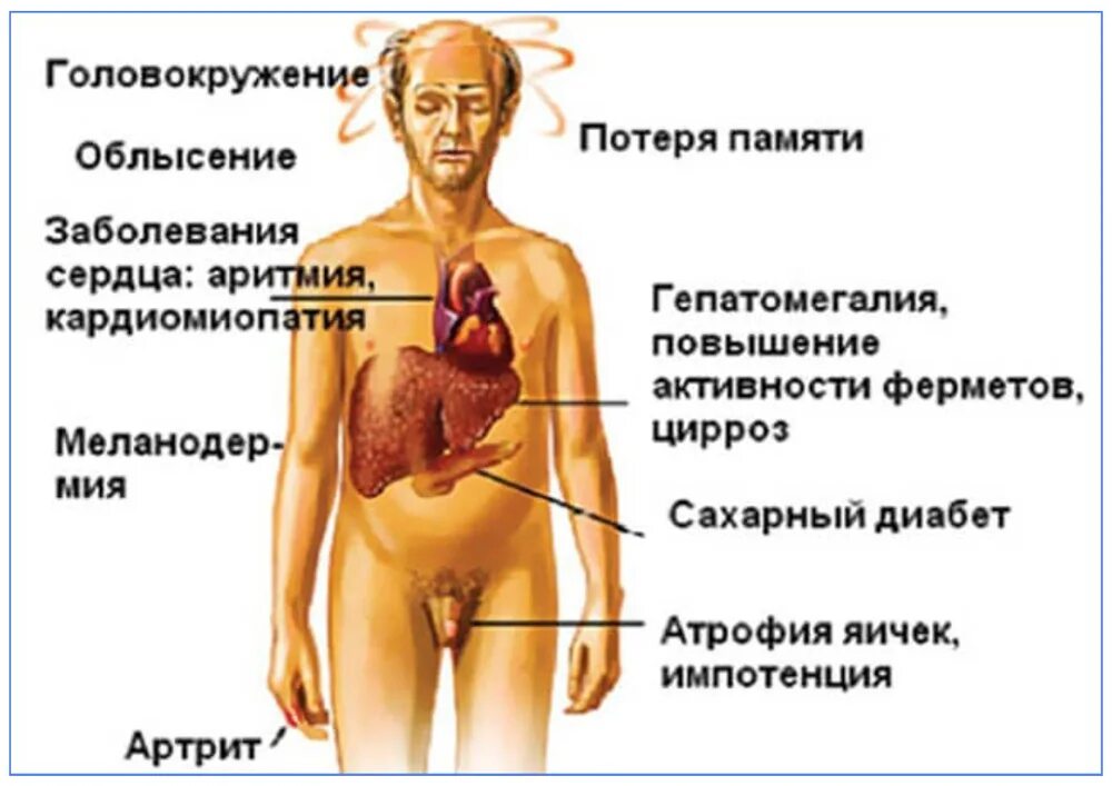 Первые симптомы печени. Гемохроматоз клинические проявления. симптомы болезни печени. внешние проявления цирроза печени.