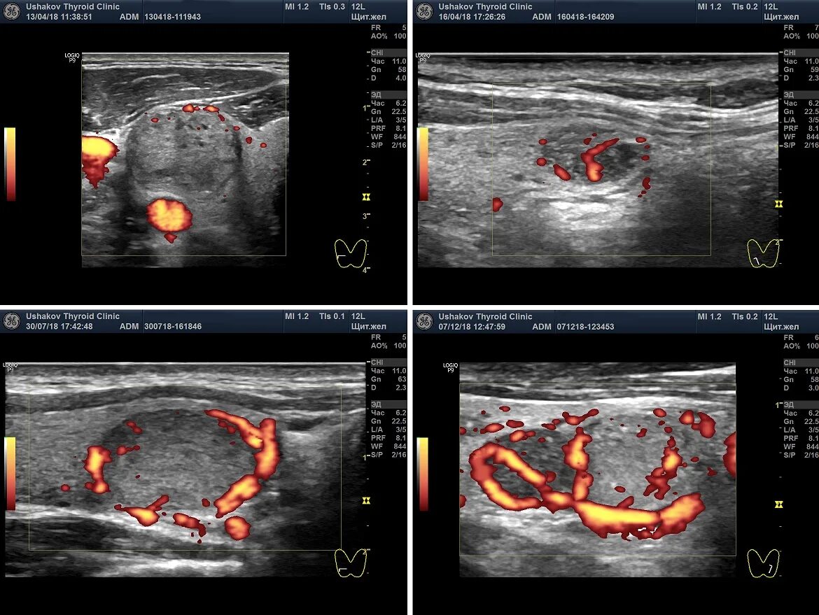 Увеличился узел щитовидной железы. УЗИ щитовидной железы с допплерографией. Ультразвуковая допплерография сосудов щитовидной железы.. Ультразвуковое исследование щитовидной железы с ЦДК. УЗИ щитовидной железы с допплерографией сосудов.