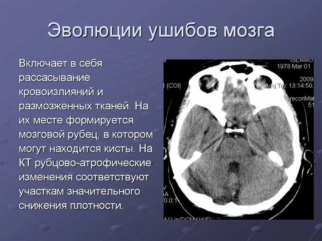 Кистозно атрофические изменения головного. Обызвествления в головном мозге. Обызвествления в головном мозге на кт. Образование головного мозга кт. Атрофические изменения.