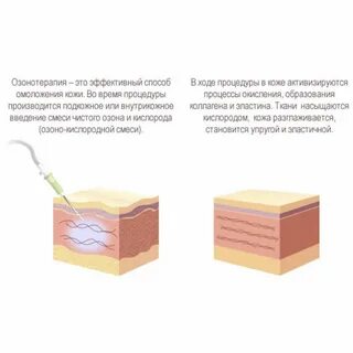 Озонотерапия обкалывание