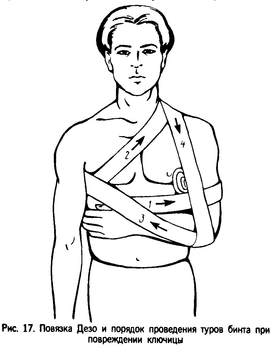 Плечевая повязка алгоритм. Десмургия повязка Дезо. Схема наложения повязки Дезо. Повязка Дезо техника наложения. Повязка Дезо при переломе правой ключицы.
