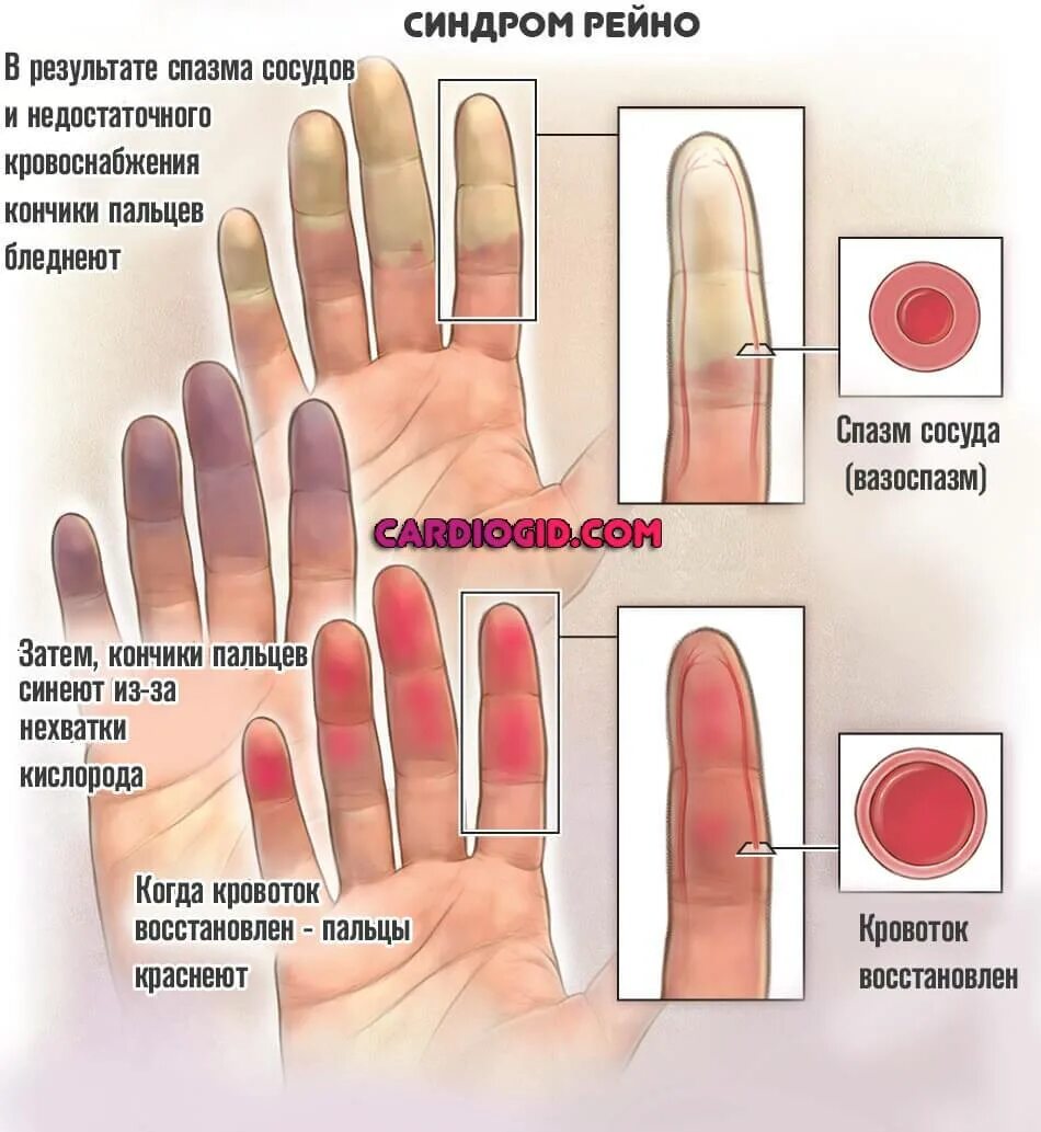 Синдром рейно это простыми словами. Поражение сосудов синдром Рейно. Спазм периферических сосудов синдром Рейно. Синдром Рейно кисти рук.