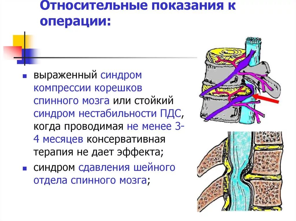 Компрессия Корешков спинного мозга. Компрессия s1 корешка позвоночника.. Сдавление Корешков спинного мозга симптомы. Компрессия спинного мозга симптомы.