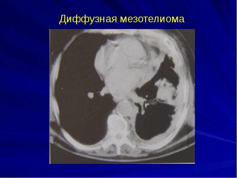 Метастазы плевры. Мезотелиома брюшины мрт. диффузная мезотелиома. канцероматоз плевры кт картина. мезотелиома брюшной полости кт.