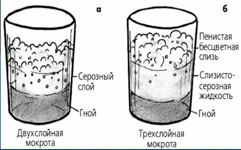 Лечение мокроты в домашних условиях. Исследование мокроты гнойная. Исследование мокроты при Бэб. Состав мокроты. Мокрота схема.