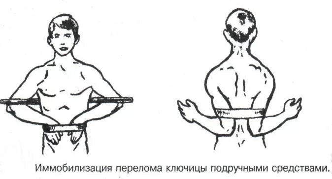 Оказание помощи при переломе ключицы. Перелом ключицы транспортная иммобилизация. иммобилизация при переломе ключицы. транспортная иммобилизация при переломе ключицы. иммобилизация при переломе ключицы и лопатки.