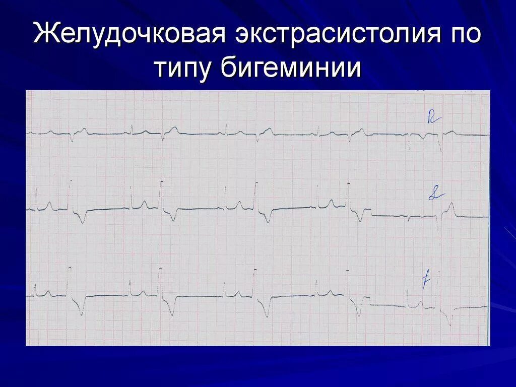 Желудочковая экстрасистолия бигеминия на ЭКГ. Желудочковая экстрасистолия квадригеминия на ЭКГ. Предсердная экстрасистолия на ЭКГ бигеминия. Экстрасистолы на ЭКГ бигеминия. Типы желудочковых экстрасистол