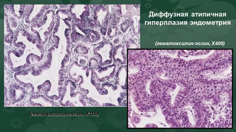 Атипическая гиперплазия эндометрия гистология. Сложная гиперплазия эндометрия гистология. Гиперплазия эндометрия гистология. Полиповидная гиперплазия эндометрия гистология. Разросся эндометрий