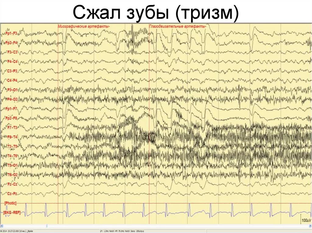 Артефакт ЭКГ на ЭЭГ. Физиологические артефакты ЭЭГ. Артефакт моргания на ЭЭГ. Артефакты ЭЭГ миограммы. Здоровая ээг