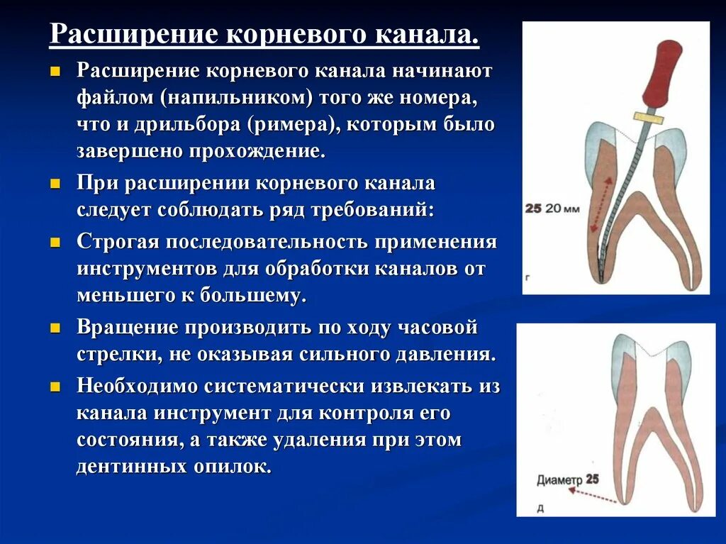 Препарирование корневого канала