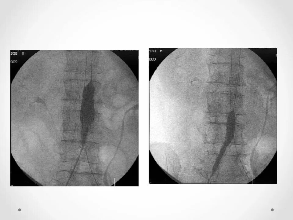 Аорта брюшной полости операция. Аневризма аорты рентген. Аневризма брюшной аорты. Аневризма аорты брюшной полости.