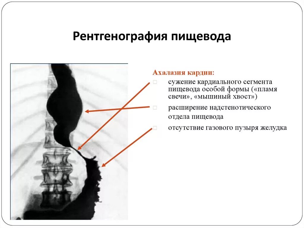 Степени расширения пищевода. Ахалазия кардии пищевода рентген. Недостаточность кардии на рентгене желудка. Ахалазия пищевода рентген степени. Ахалазия пищевода рентген признаки.