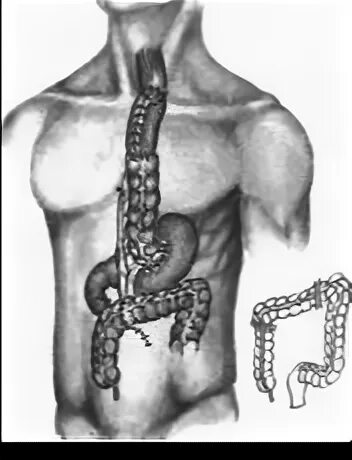Искусственный пищевод. Эзофагопластика толстой кишкой. Пластика пищевода толстой кишкой. Трансплантация толстой кишки. Трансплантация Толстого кишечника.