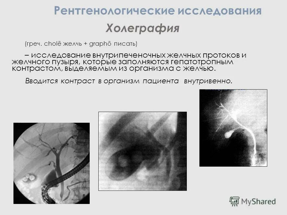 Какие исследования желчного пузыря. Рентгеноконтрастное исследование желчного пузыря. рентгенологический метод исследования желчного пузыря. рентгенологические исследования (холецистография, холангиография):. рентген исследования желчного пузыря.