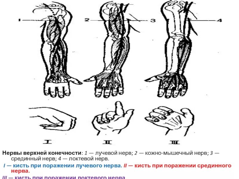 Поражение нервов руки. Синдром поражения лучевого нерва. Поражение мышечно-кожного нерва симптомы. Симптомы повреждения нервов верхней конечности. Симптомы поражения нервов верхней конечности.