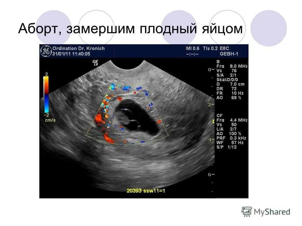 Замершая на 7 неделе причины. Неразвивающаяся беременность УЗИ. 7 Недель деформация плодного яйца УЗИ. Деформация плодного яйца на УЗИ. 8 Недель беременности деформированное плодное яйцо УЗИ.