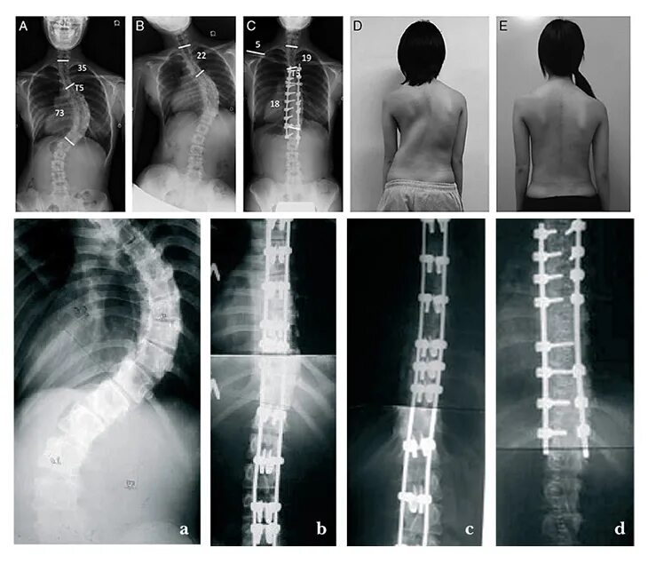 Операции на 4 стадии. Сколиоз 2 степени рентген. Кифоз 3 степени рентген. Сколиоз 1 степени.кифоз. Сколиоз кифоз 3 степени.
