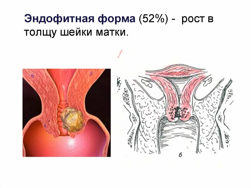 Форма рака матки. Рост опухоли шейки матки. Эндофитная опухоль шейки матки. Экзофитная опухоль шейки матки.