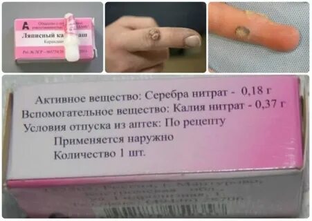 Сколько раз нужно прижигать