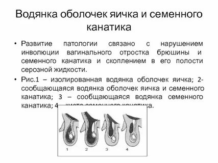 Что такое брюшная водянка
