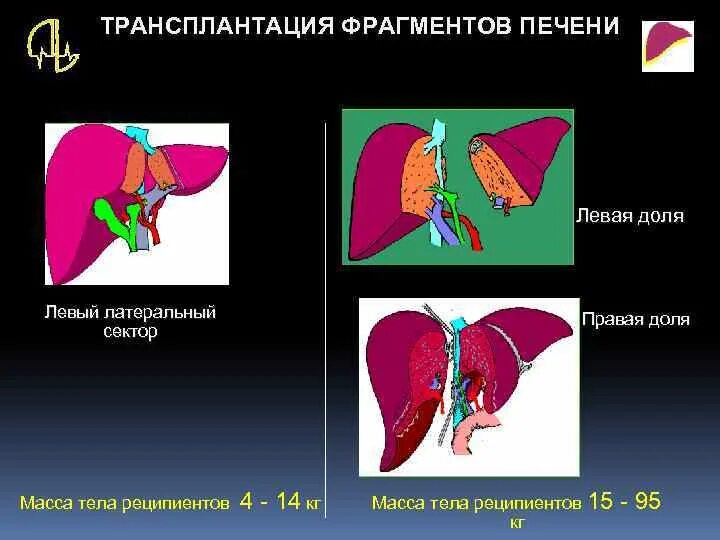 Техника ортотопической трансплантации печени. Трансплантация печени схема. Трансплантация части печени. Трансплантация печени операция. Можно ли пересадить печень