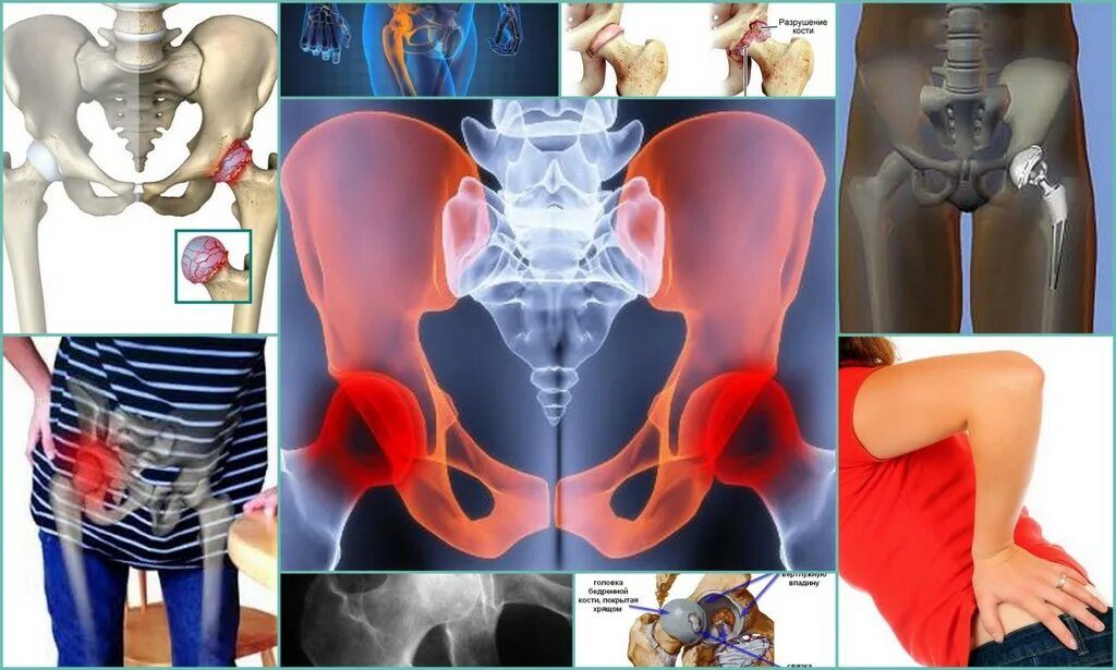 Какая боль при коксартрозе. Посттравматический коксартроз. Коксартроз тазобедренного сустава симптомы. Вертельный бурсит тазобедренного. Коксартроз 2 степени тазобедренного.