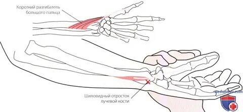 Теносиновит сухожилия пальца