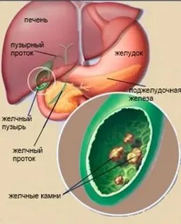 Желчный пузырь без операции