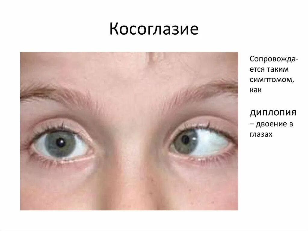 Двоение в глазах лечение. Косоглазие. Косоглазие глаза. Нарушение зрения диплопия.