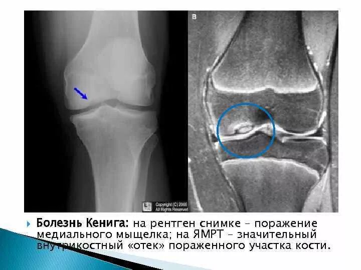 Повреждение мыщелка. Остеохондропатия Кенига. Болезнь Кенига коленного сустава рентгенологическая картина. Остеохондропатия Кенига кт.