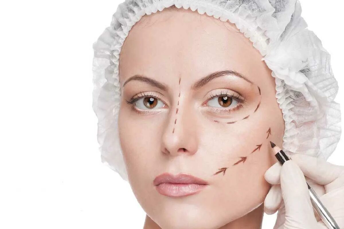 Radiesse векторный лифтинг. векторный лифтинг википедия. векторный лифтинг википедия. нитевой лифтинг. лифтинг радиесс (radiesse) векторный.