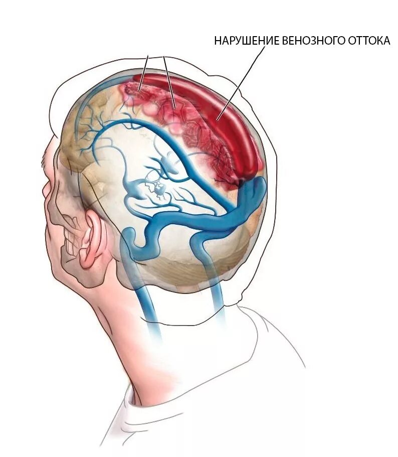 Венозная дисциркуляция головного мозга что это такое. Венозный отток головного мозга. Нарушение венозного оттока головного.