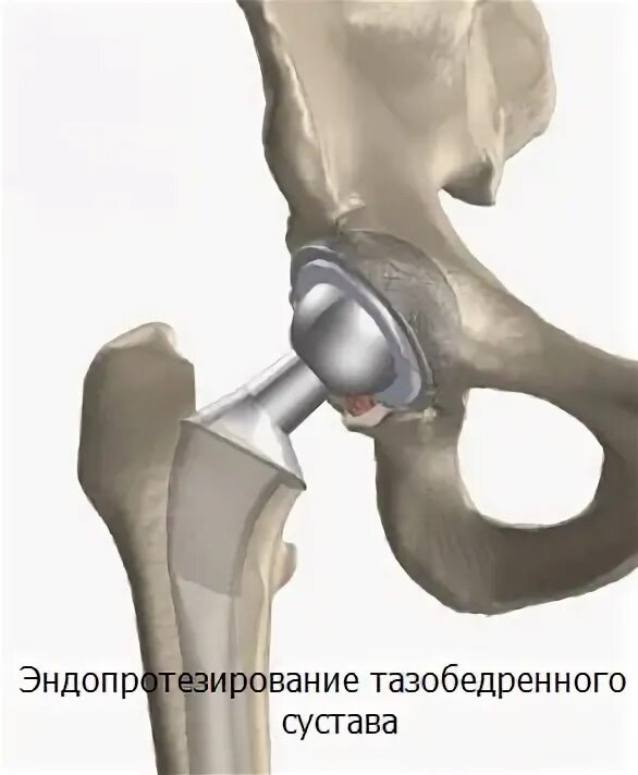 Артропластика тазобедренного сустава. Эндопротезирование тазобедренного сустава операция. Операция эндопротез тазобедренный. Эндопротезирование тазобедренного сустава швейцарский сустав. Инвалидность после эндопротезирования